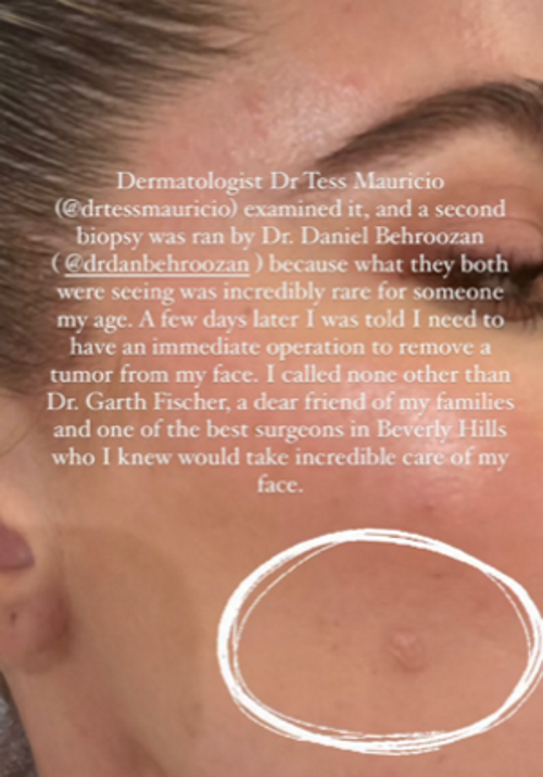 khloe kardashian skin cancer